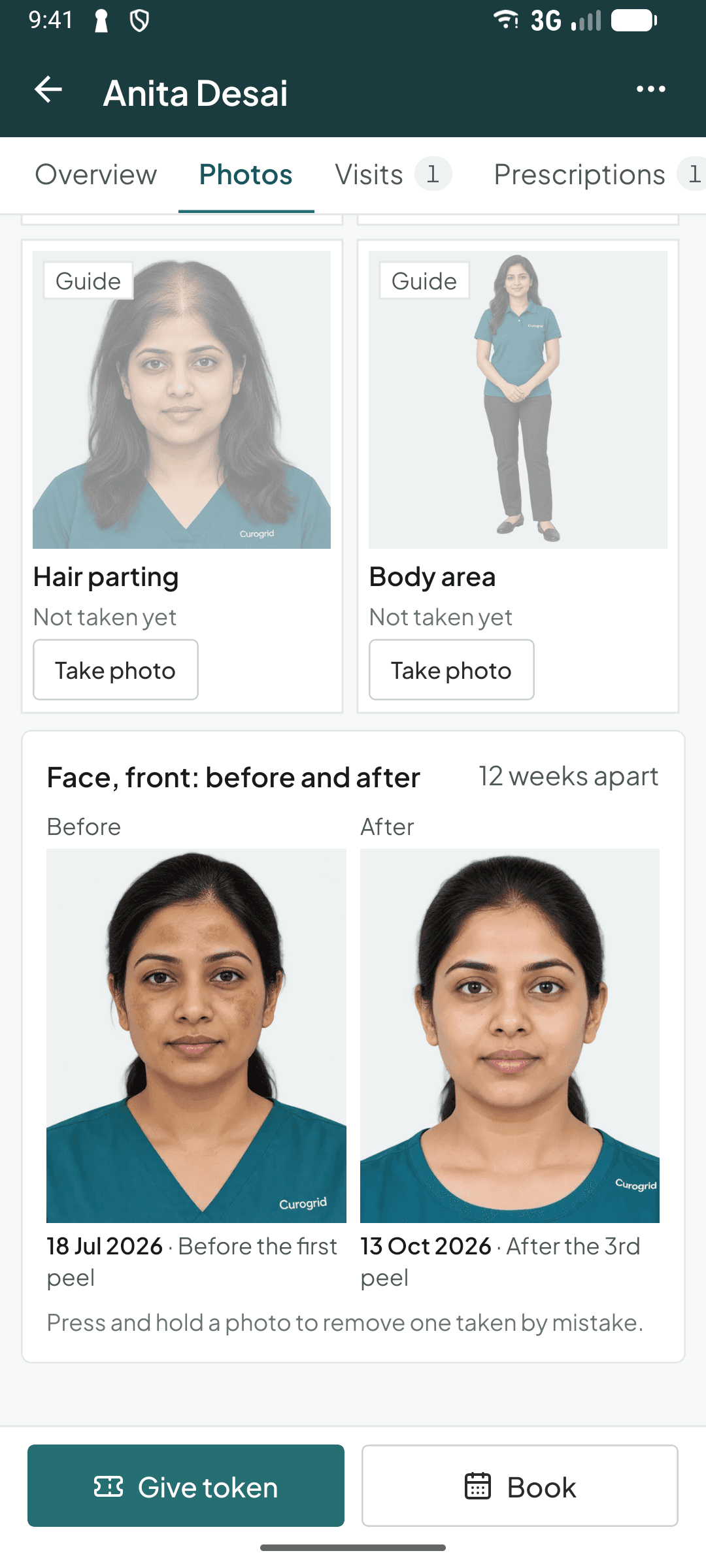 A face before and after treatment, side by side, in the Curogrid Derma phone app