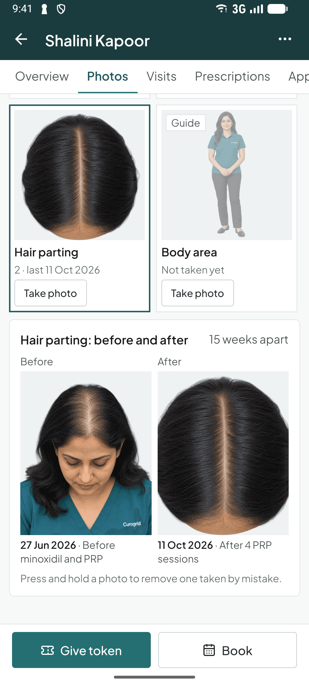 A hair parting before and after PRP in the Curogrid Derma phone app