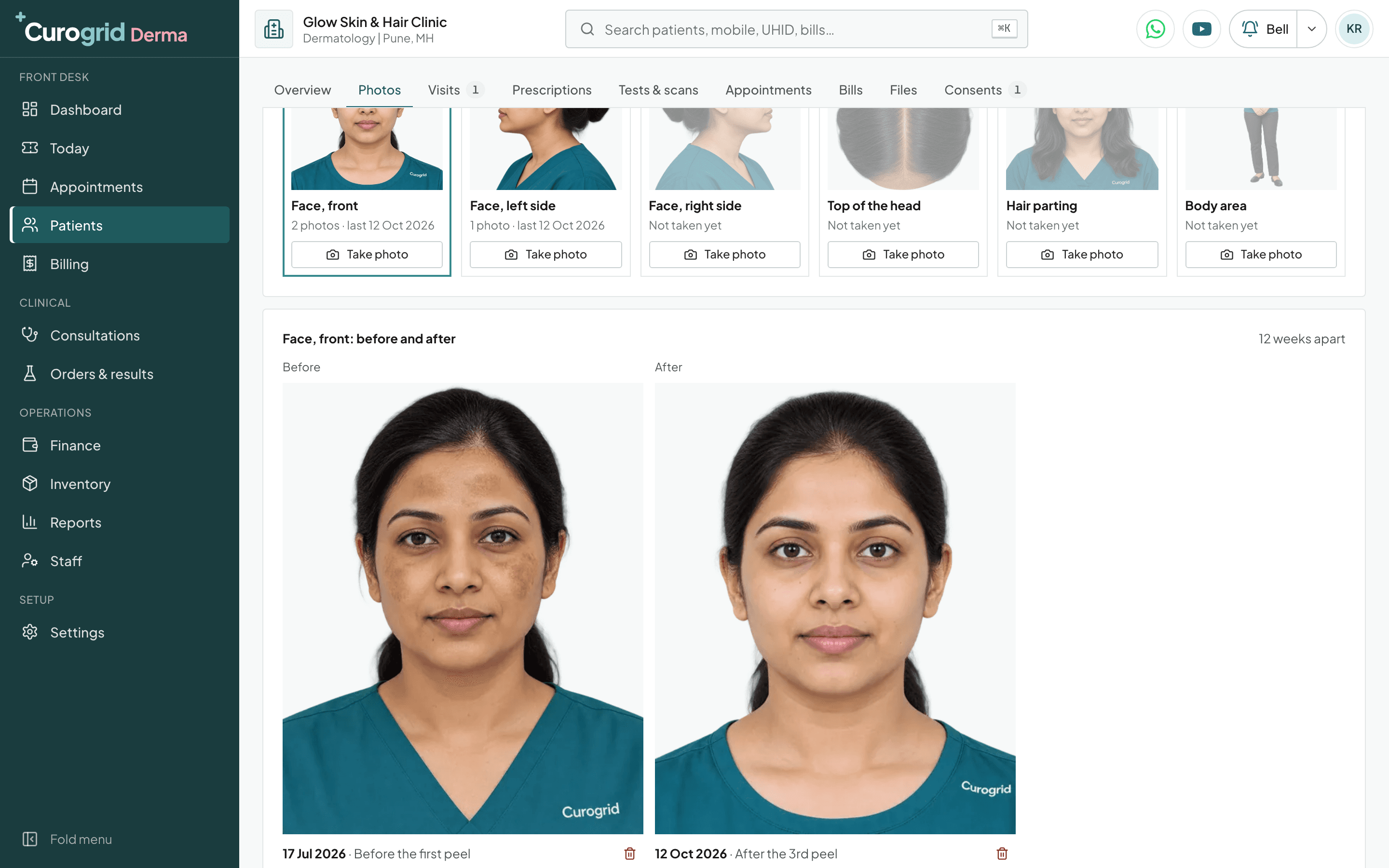 Curogrid Derma's Photos tab: a melasma patient's face from the front before and after, 12 weeks apart, on 17 Jul 2026 before the first peel and on 12 Oct 2026 after the 3rd peel, under a row of six standard angles