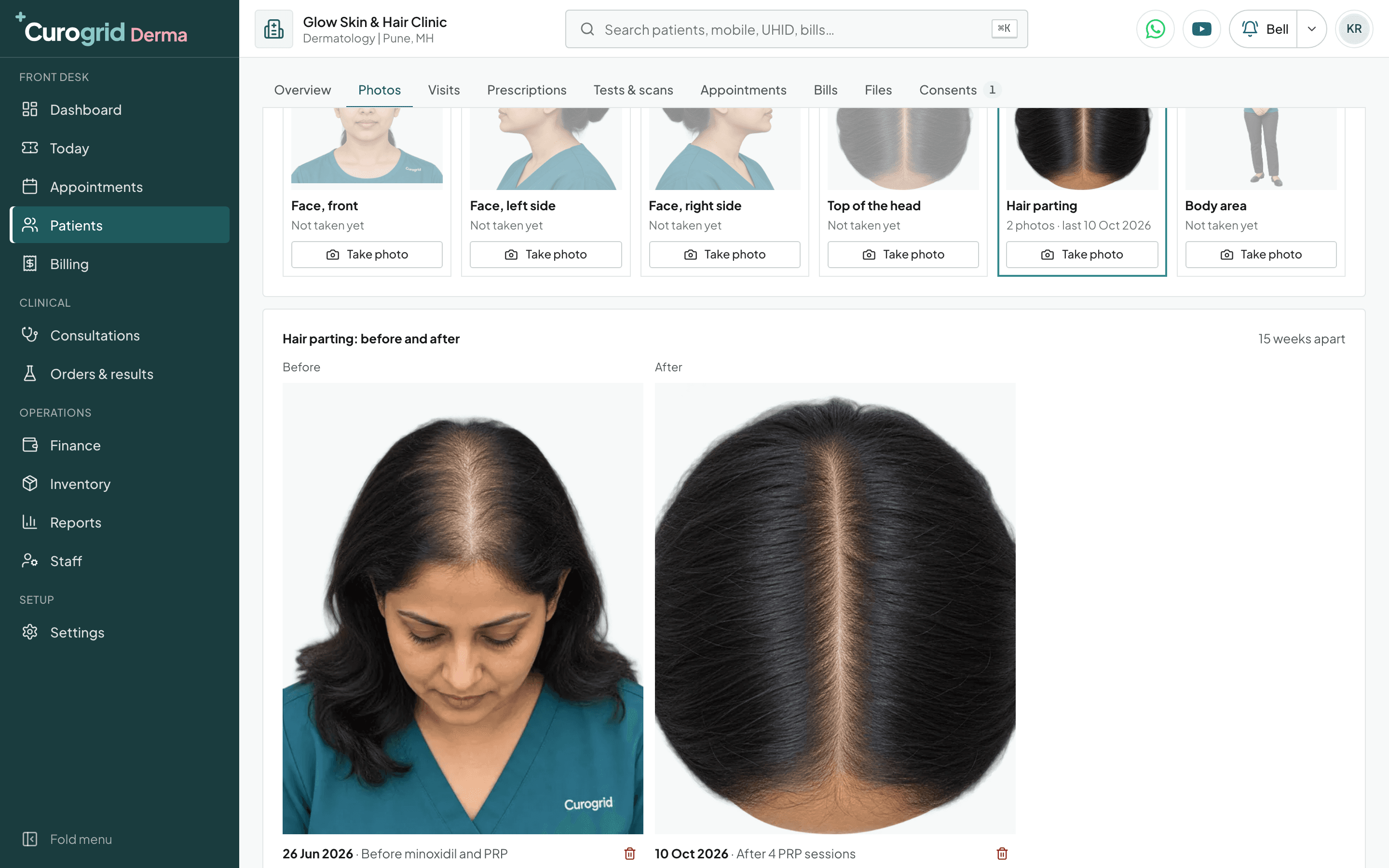 Curogrid Derma's Photos tab: a woman's thinning hair parting before minoxidil and PRP on 26 Jun 2026, and after 4 PRP sessions on 10 Oct 2026, 15 weeks apart